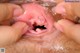 A close up of a person's tongue being examined by a doctor.